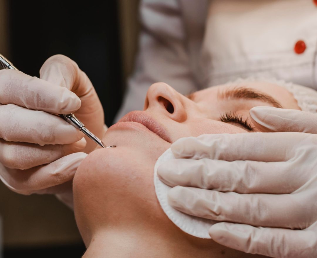 estrazione punti neri viso